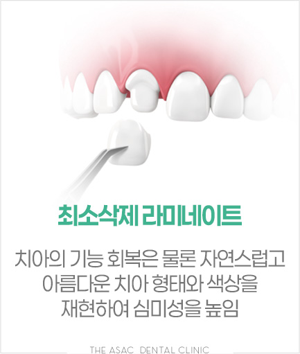 최소삭제 라미네이트