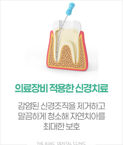 의료장비 적용한 신경치료