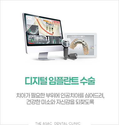 디지털 임플란트 수술