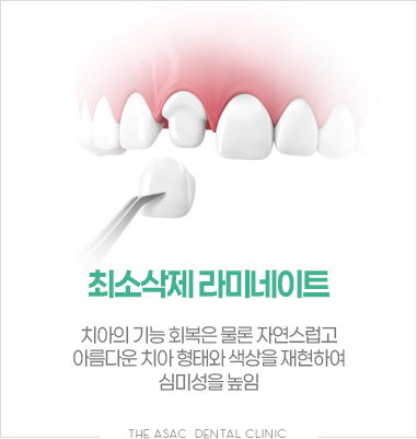 최소삭제 라미네이트