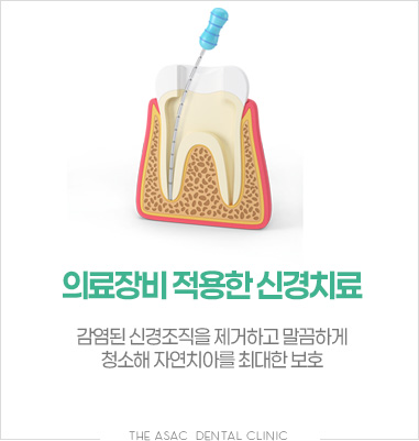 의료장비 적용한 신경치료