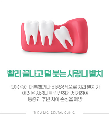 빨리 끝나고 덜 붓는 사랑니 발치