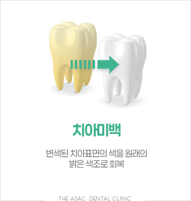 치아미백